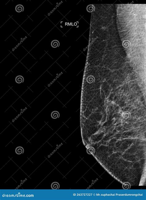 mammography biweekely compression test|mammogram results bi rads.